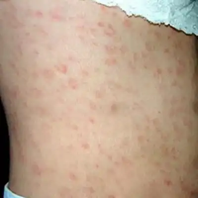 硬下疳初期图片8