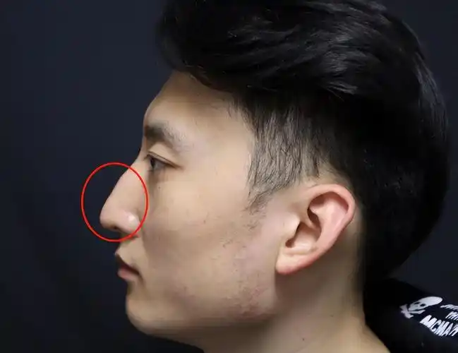 做的鼻子取出来可以恢复到原来吗,28岁小伙"驼峰鼻"歪鼻矫正手术记录