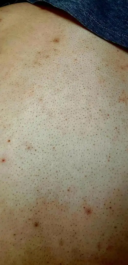 背后的毛孔看的一清二楚,不是黑点,就是每个毛孔里有细细的黑毛,曾经