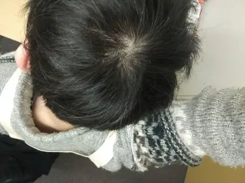 发旋头发变少,是不是要秃顶了(有图)