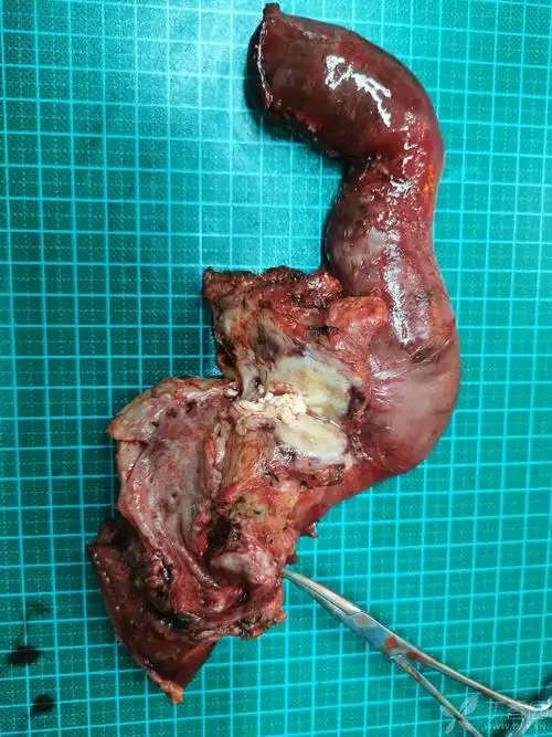 胰腺结石导致慢性胰腺炎,甚至胰腺癌