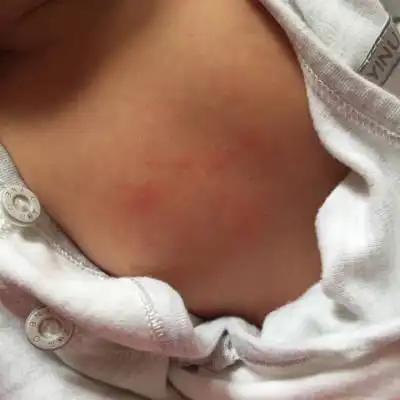 宝宝满月了,身上一片一片红,怎麼回事