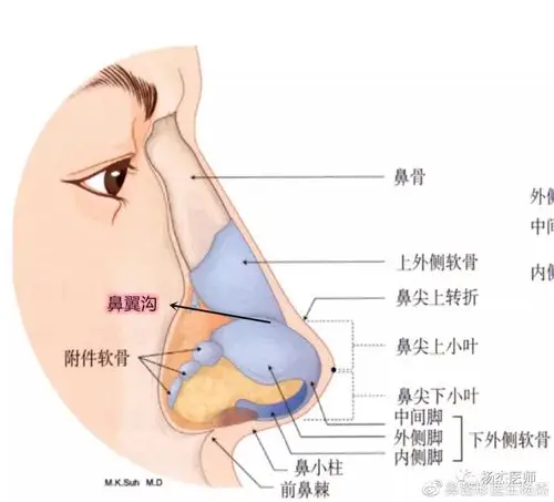 此沟不能少鼻翼沟成形在鼻头缩小中的重要作用
