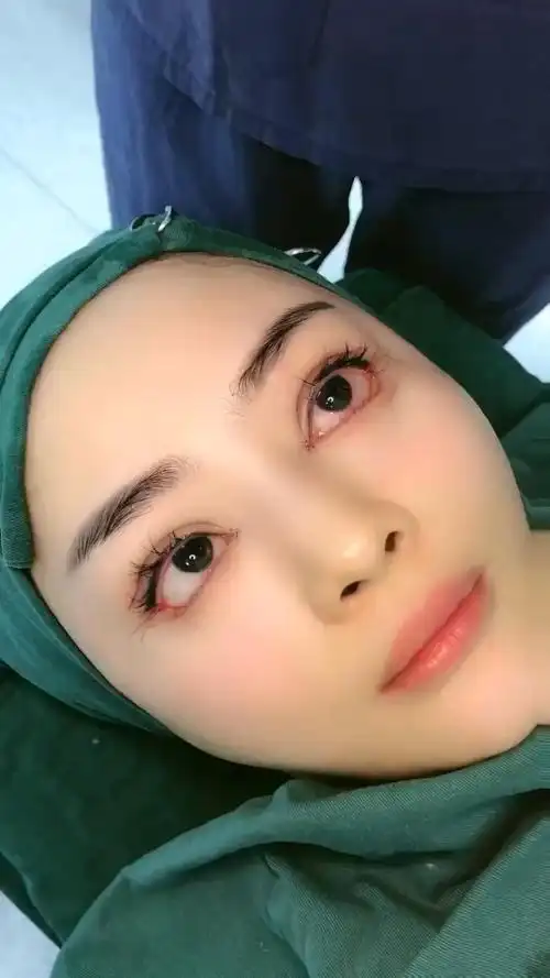 做了个韩式大芭比眼