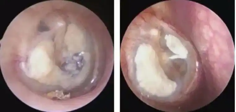 可见鼓膜钙化斑鼓室体瘤耳内镜下透过鼓膜可见中耳腔红色血管性新生物