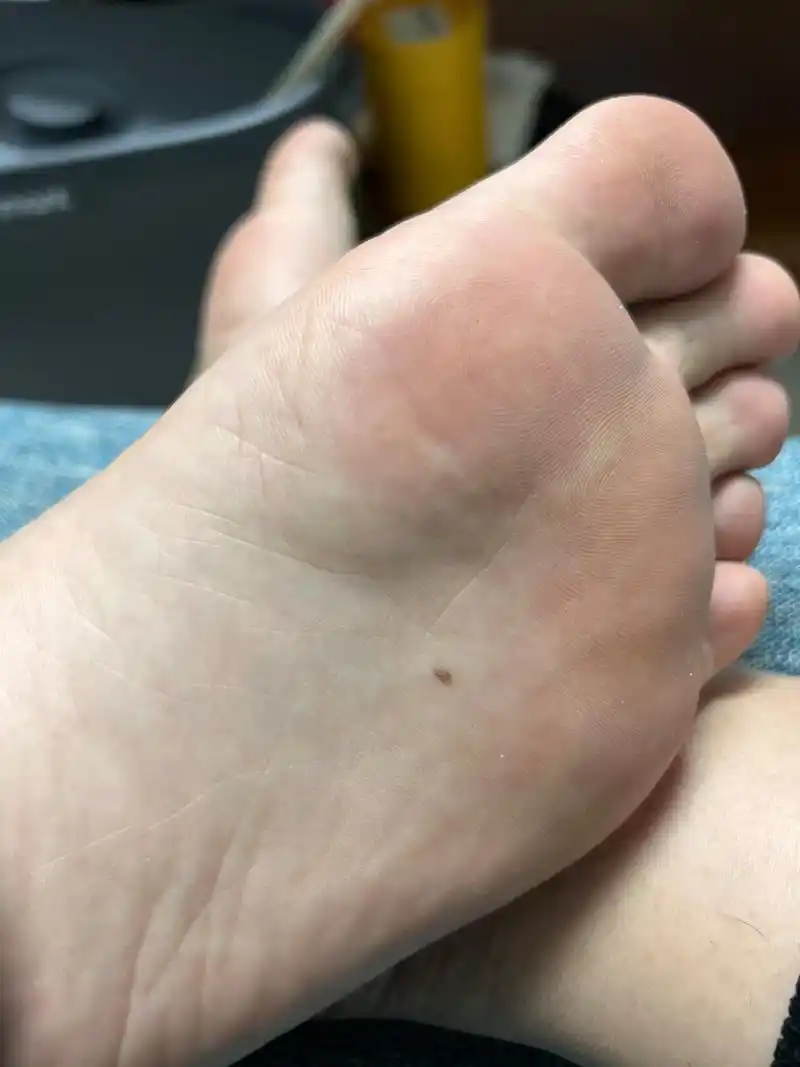 脚底长痣有啥事吗 一个新长的一个一直有 左边脚心不知道啥时候长的
