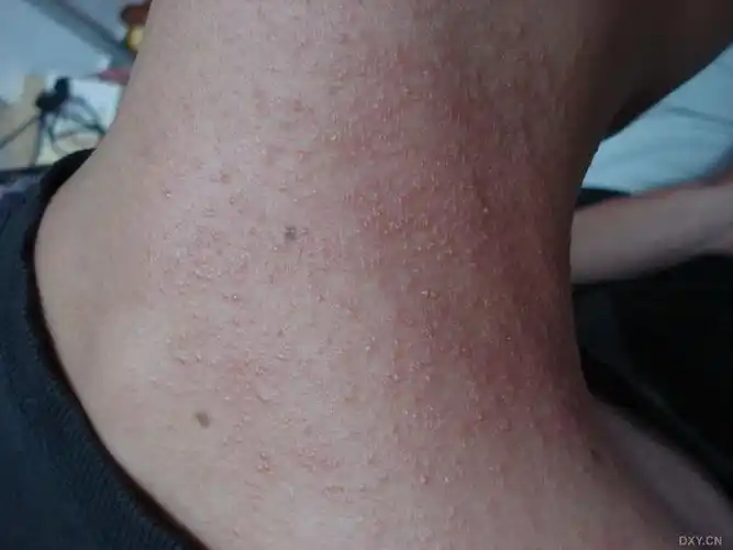 【请教】皮肤过敏?接触性皮炎?指导病例处理 [病例帖]