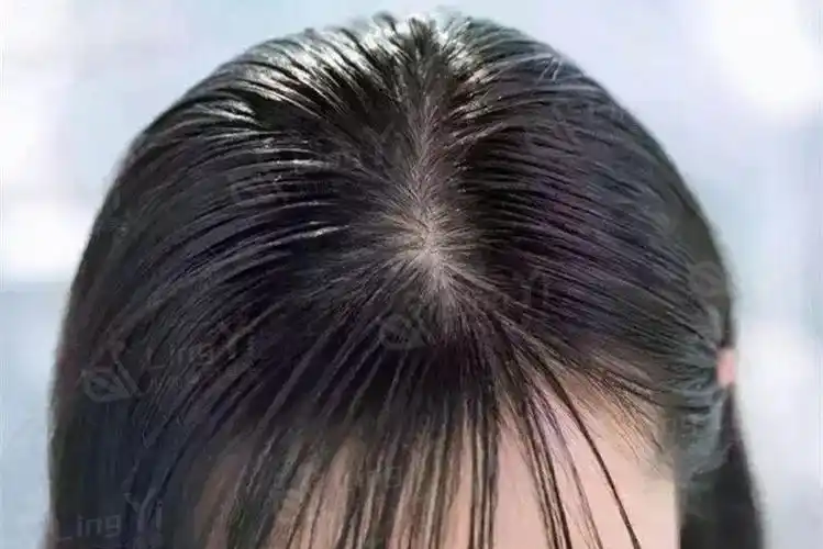 头皮出油