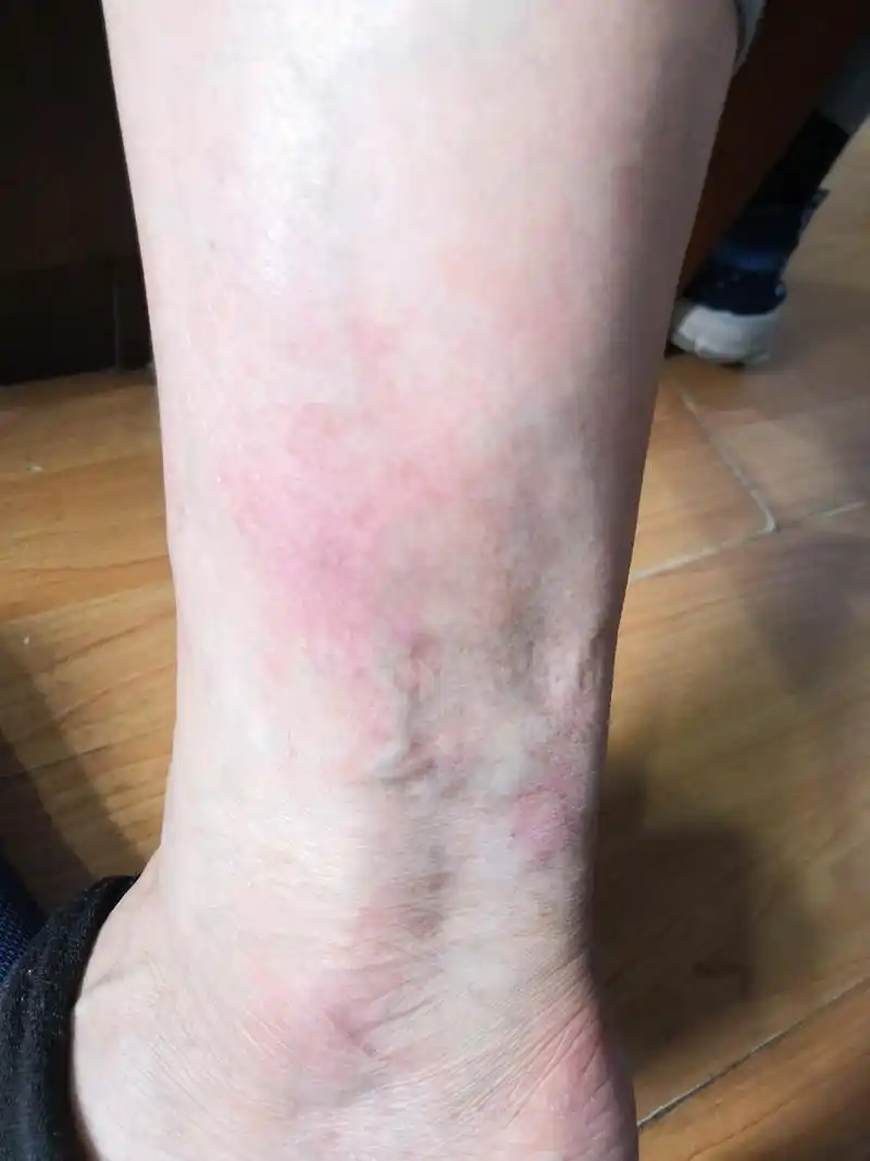 脚踝部反复发作湿疹3年余