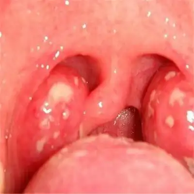 扁桃体恶性肿瘤