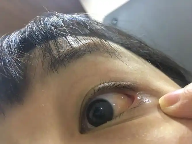 我的眼睛怎么啦! 刚开始痒痒的 揉完之后就这样了