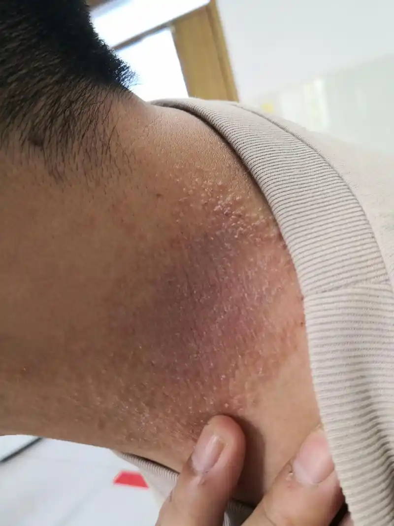 考虑神经性皮炎/特应性皮炎#解决皮肤问题专注皮肤美容# .