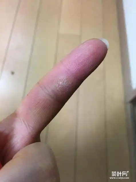 皮肤里面有硬疙瘩会痒 艾滋病疙瘩真实图片