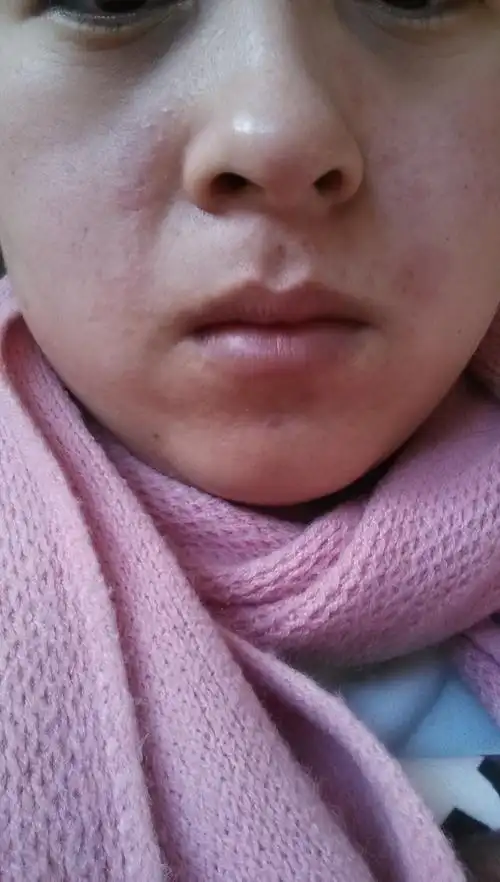 鼻子两边有红红的杠杠,有点痒,热起来就红,冷了就推下去了