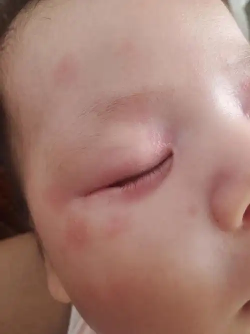 家家户户!新生儿荨麻疹症状"荣华富贵"-第2张图片-克子博客