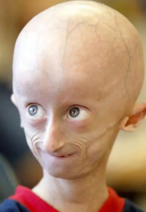 早衰症早衰症是一种极端罕见的遗传病,其患者身体的老化过程十分快速