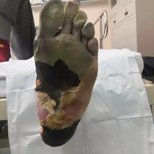 糖尿病严重的并发症--糖尿病足_糖尿病足_糖尿病足介绍 - 好大夫在线