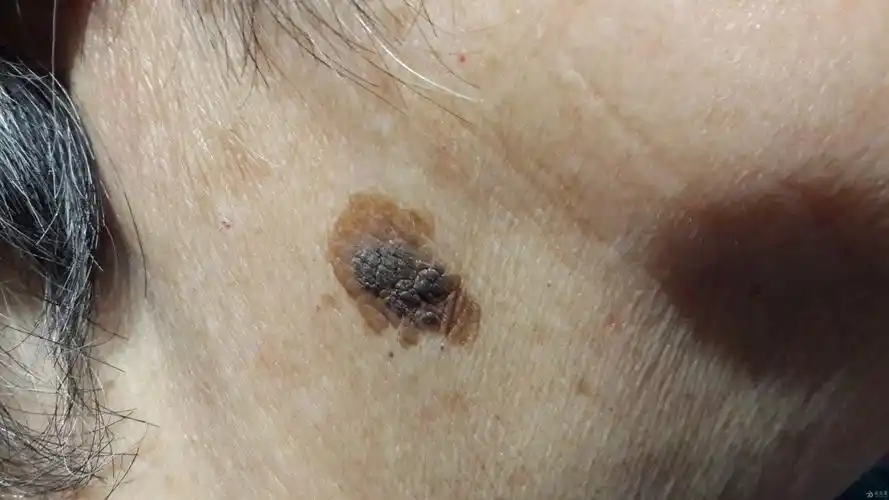 请诊断以及是否需要手术治疗 - 皮肤及性传播疾病讨论版 - 爱爱医医学