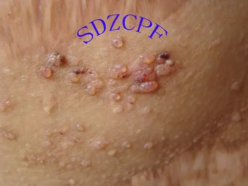 淋巴管瘤,请诊断,治疗 - 皮肤及性传播疾病讨论版 - 爱爱医医学论坛