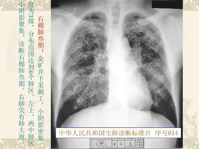 我国尘肺x线诊断标准片解读ppt