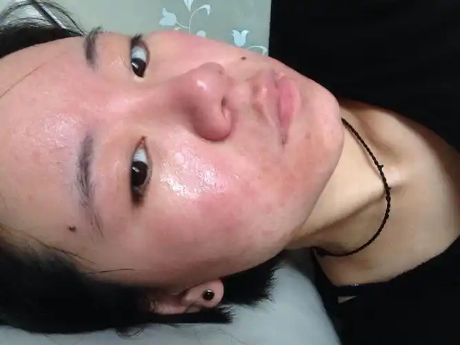 求大神鉴定这属于什么类型的过敏,脸很烫很红,今年反复几次了,症状一