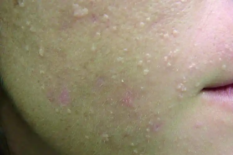 扁平疣早期图片