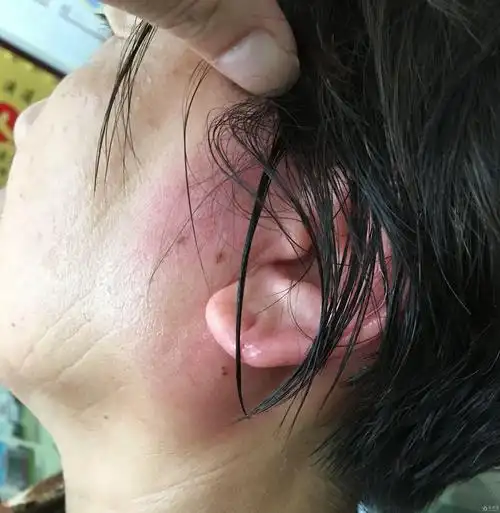 左侧耳部肿痛1天原创