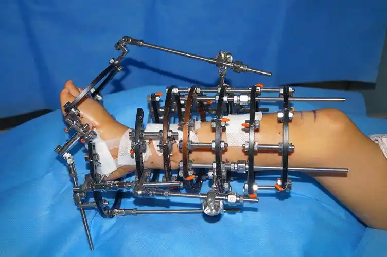 外固定支架护理小贴士