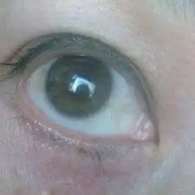 眼白上有黄点?红血丝?你该警惕了!