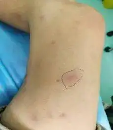 四肢麻木皮肤红斑持续6年之久原是麻风病作怪基层医疗练就火眼金睛是