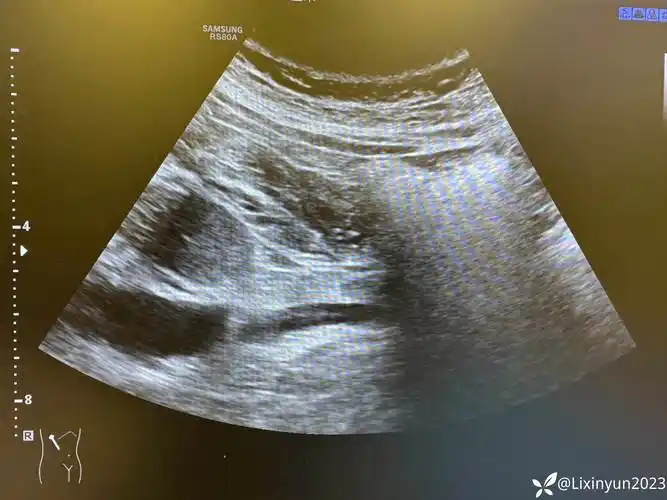 肥胖人腰疼(肾结石)