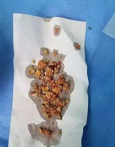 (排出体内的结石)