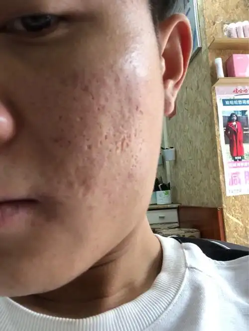 我这种痘痘还有痘坑该怎么办?