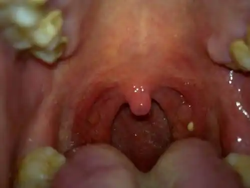 喉结核为耳鼻咽喉结核中最多见者,该病多由开放性肺结核经气道播散