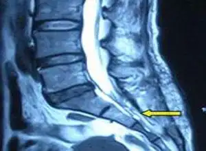 骶骨囊肿,骶骨囊肿的原因,骶骨囊肿怎么办-外科-骨外科-症状查询-寻医