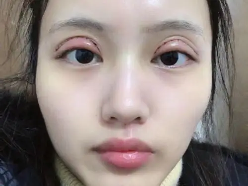 [:163]体验前变美诉求:我是单眼皮,眼窝凹陷,_圈子-新氧美容整形