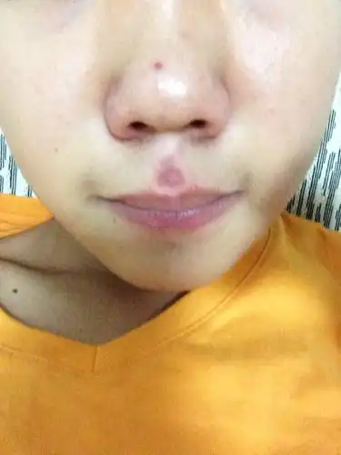 怎么办啊我的人中那块长了个痘痘被我挤了现在留下疤痕了