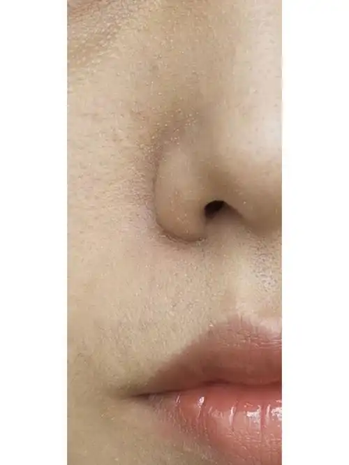 粉刺闭口黑头一样不少