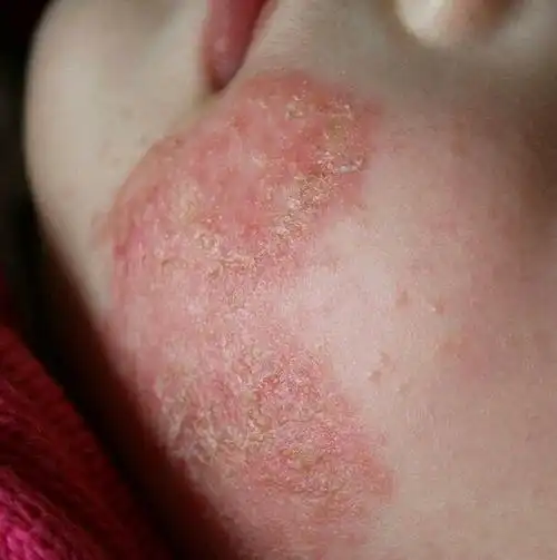 宝宝湿疹有什么好办法?不希望用那些激素和抗生素之类的东西