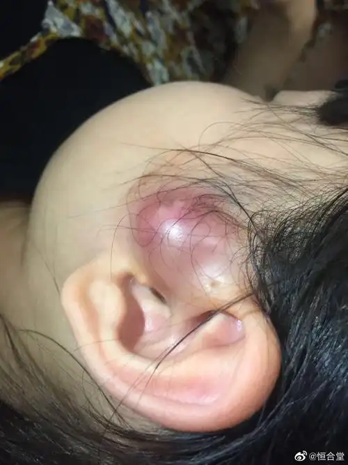 耳前瘘管你家宝宝有吗