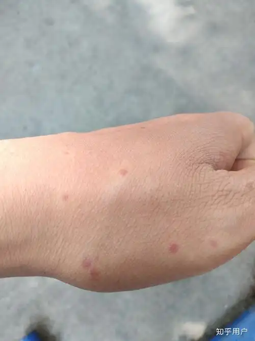 同样是被蚊子咬为什么有些人是一个大包有些人是一个小红点