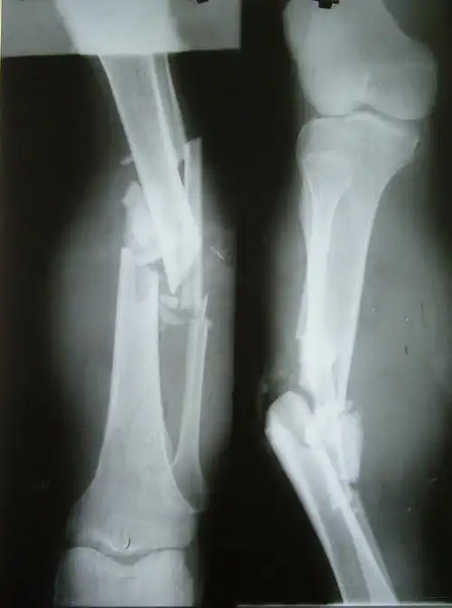 创伤左小腿开放性骨折