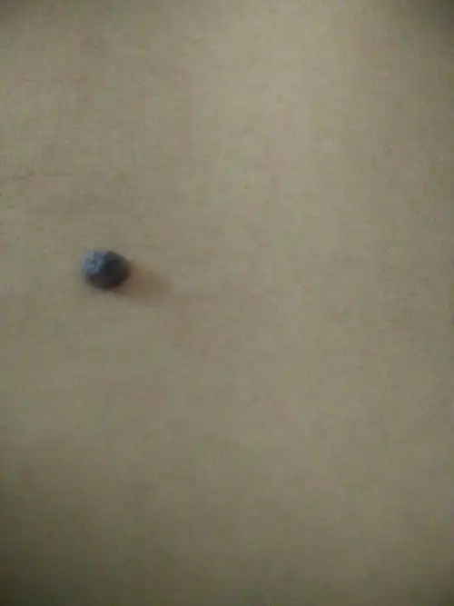 这肚子上的痣那么大,颜色不均匀,是不是有什么问题?