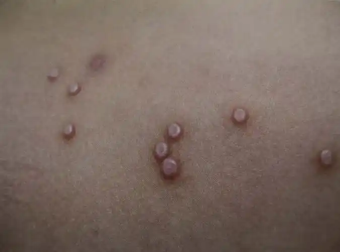 传染性软疣症状_病因_治疗方法_鉴别_专家咨询|丁香医生