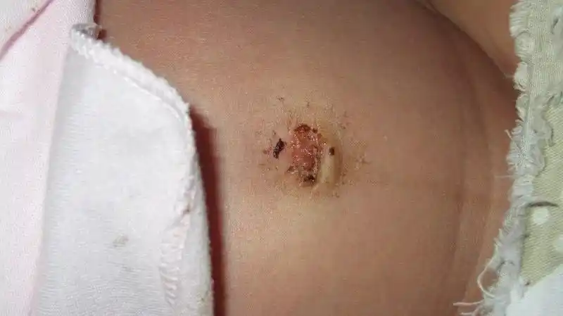 今天脐带结痂刚掉的,刚开始有些异味,消