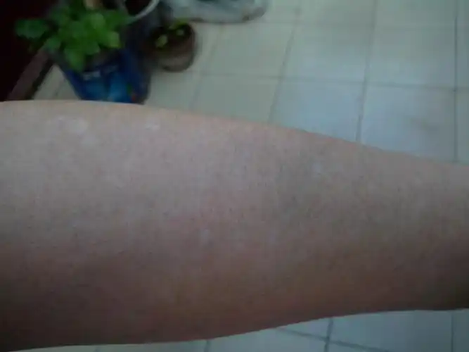 我想知道 皮肤上张小白点是什么病么?