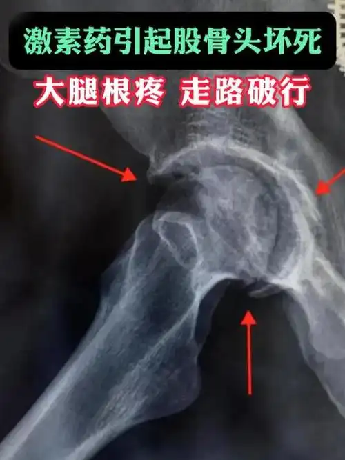 激素药引起股骨头坏死 大腿根疼 走路跛行 股骨头坏死 郭晓忠 关注股