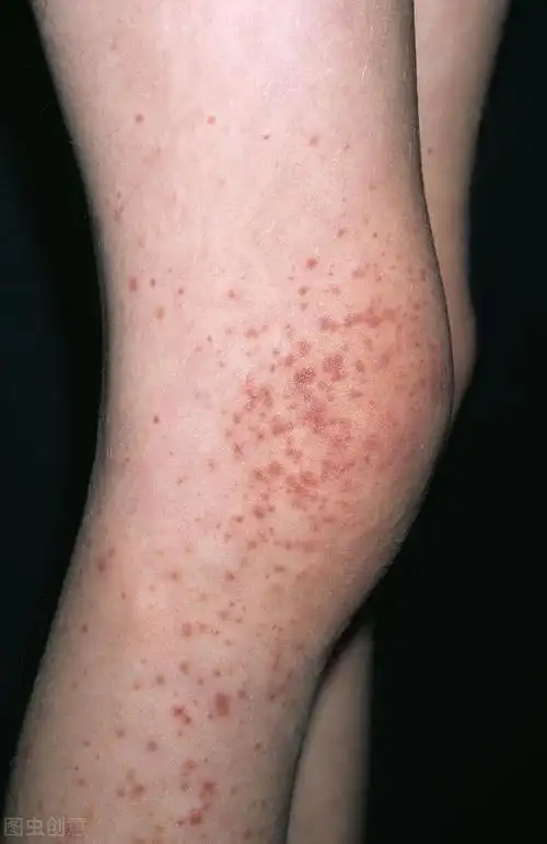 皮肤上有小红血点图片(当你发现身上莫名出现小红点时小心这种疾病)