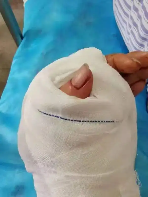 直到医生将他的手指再植成功,看着左手厚厚的白色纱布,心情平复下来后