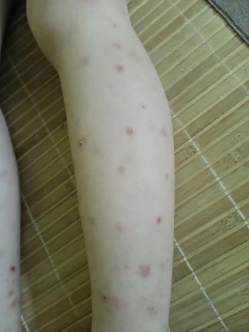 孩子的腿被蚊子咬的不成样子了,今年的蚊子怎么这么厉害呢?